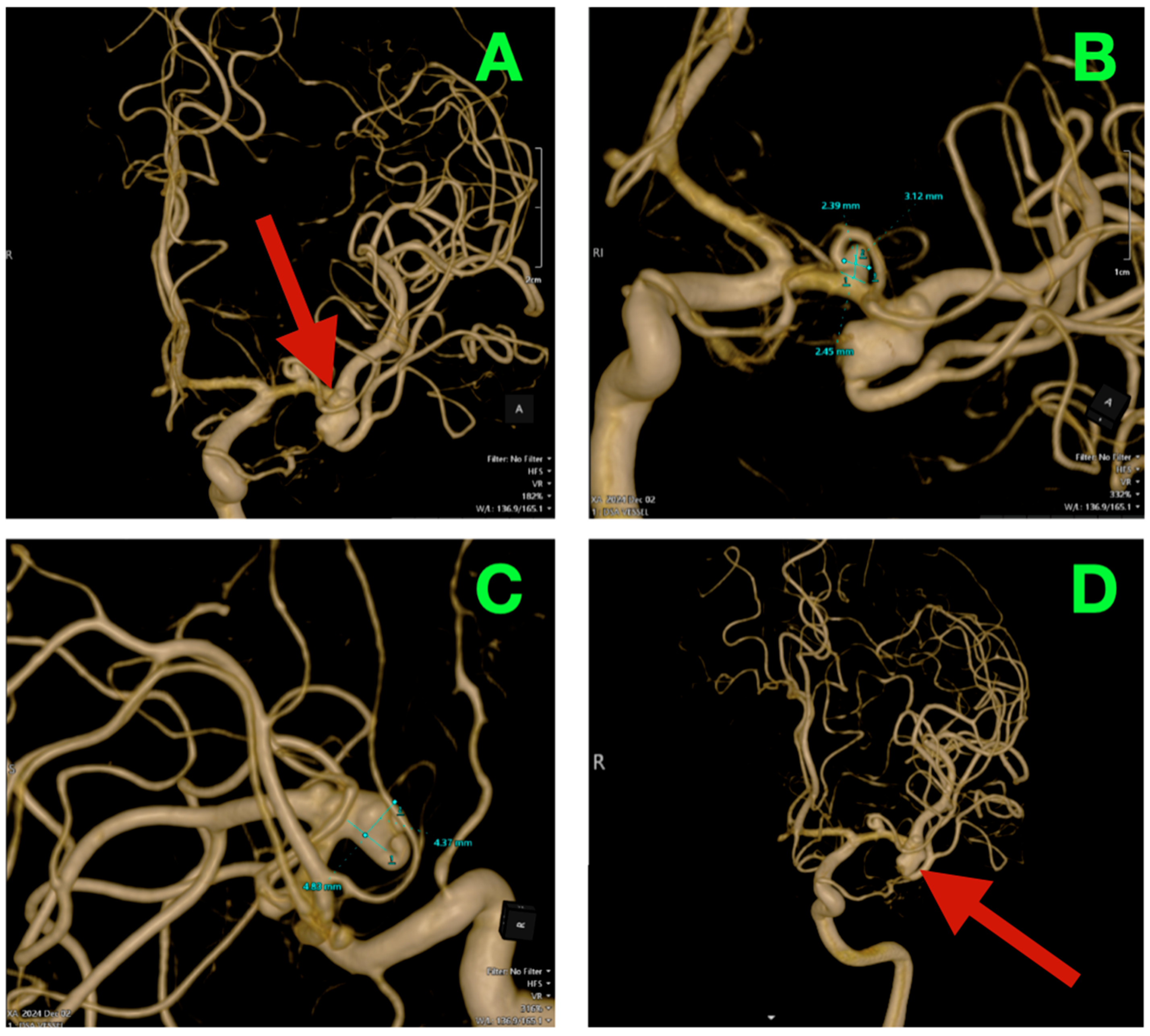 Neuroangiography procedure